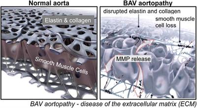 Evolution of Precision Medicine and Surgical Strategies for Bicuspid Aortic Valve-Associated Aortopathy